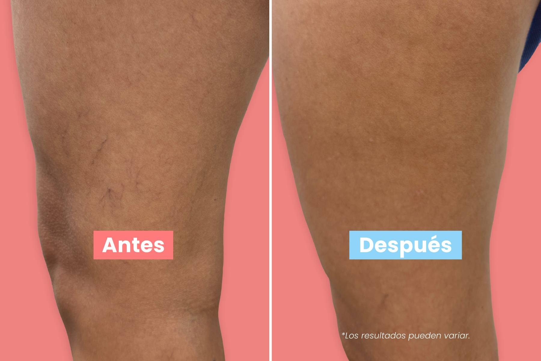 Mu&eacute;strale un poco de amor a tus piernas con simples consejos de cuidado venoso que mejoran la comodidad, la circulaci&oacute;n y la confianza. Las piernas saludables se sienten mejor.