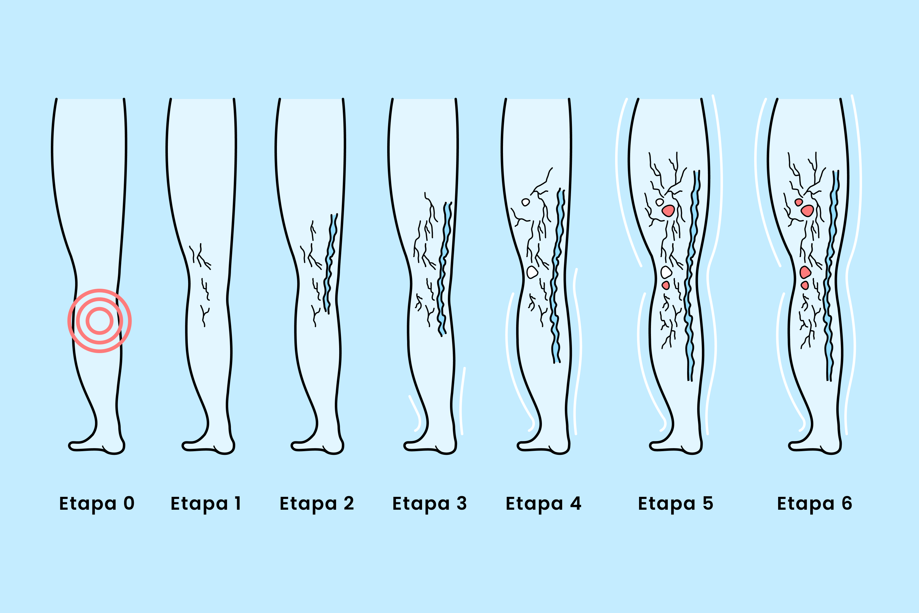 Detr&aacute;s de los problemas de salud cotidianos se esconde una amenaza silenciosa que a menudo pasa desapercibida hasta que alcanza sus etapas avanzadas: la insuficiencia venosa cr&oacute;nica (IVC),  tambi&eacute;n conocida como enfermedad venosa.