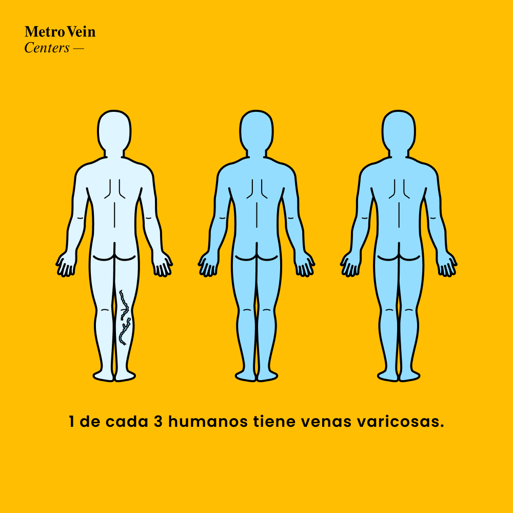 Detr&aacute;s de los problemas de salud cotidianos se esconde una amenaza silenciosa que a menudo pasa desapercibida hasta que alcanza sus etapas avanzadas: la insuficiencia venosa cr&oacute;nica (IVC),  tambi&eacute;n conocida como enfermedad venosa.