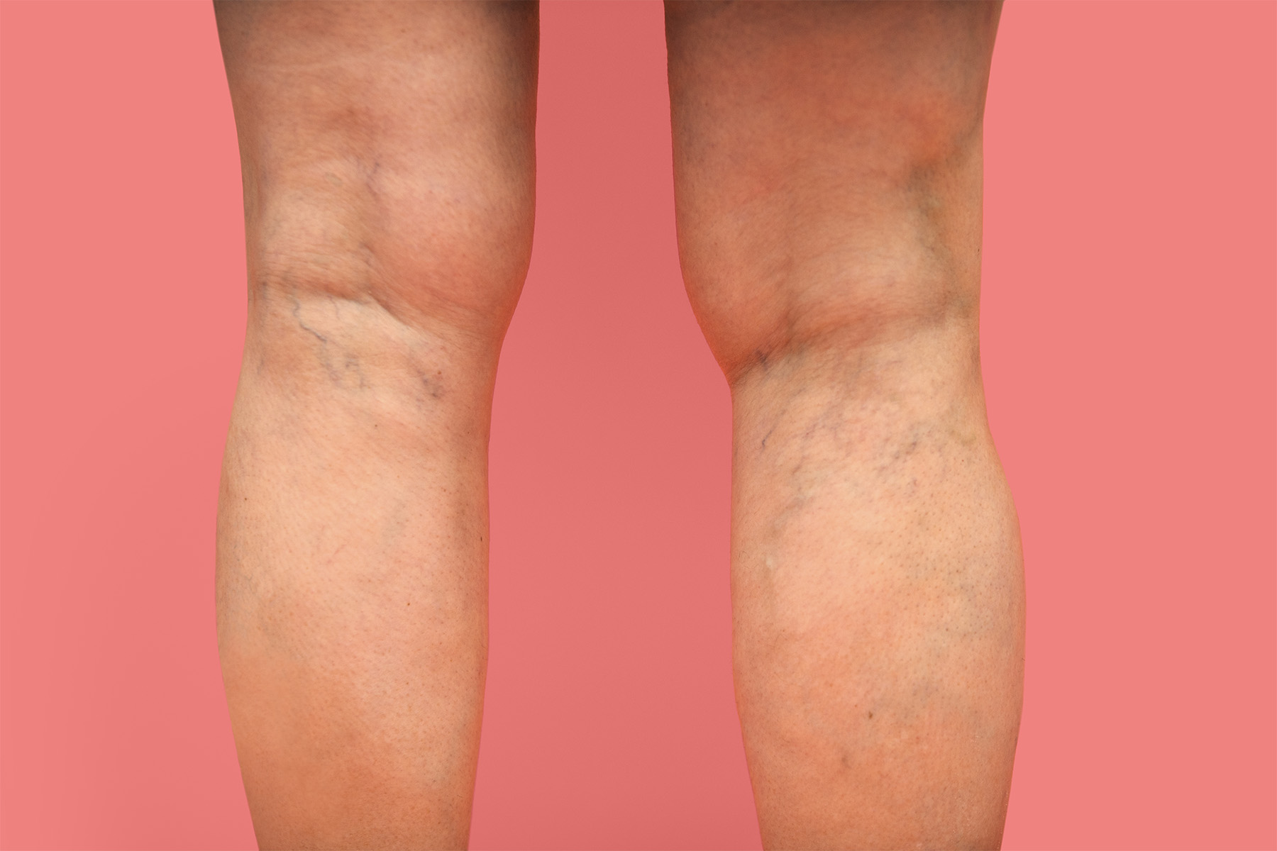 La salud venosa favorece la circulación, la energía y la movilidad. Prevenga las várices, la insuficiencia venosa crónica (IVC), la hinchazón y la pesadez en las piernas con hábitos simples de bienestar.