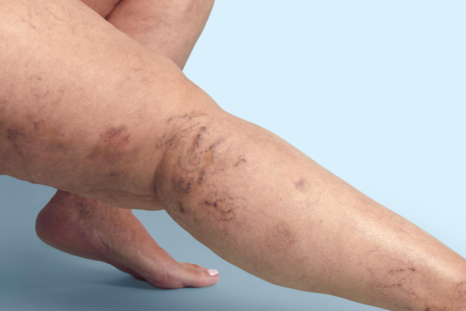 Primer plano de una pierna con arañas vasculares y pequeñas varices cerca de la rodilla