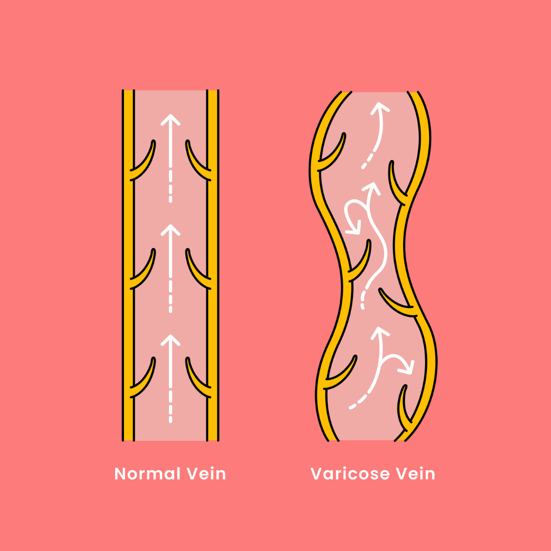 Varicose Veins: 7 Signs You Need to See a Vein Specialist